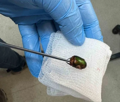Ağrı ve işitme kaybı nedeniyle hastaneye gitti, kulağından Japon b&ouml;ceği &ccedil;ıktı