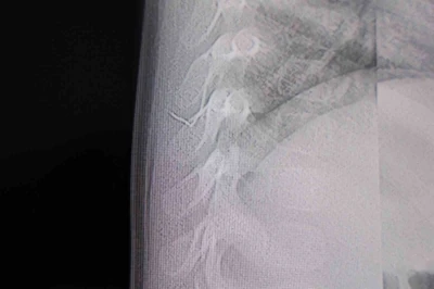 Bebeğin sırtından tel par&ccedil;ası &ccedil;ıktı