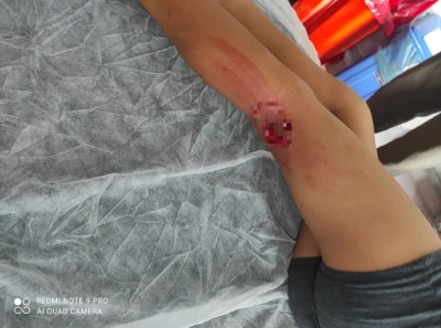 Bursa'da başıboş k&ouml;pek saldırısı