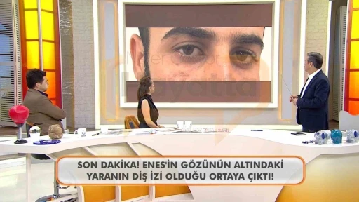 Canlı yayında Enes G&uuml;ran&rsquo;ın g&ouml;z&uuml;n&uuml;n altındaki diş izine dikkat &ccedil;ekildi

