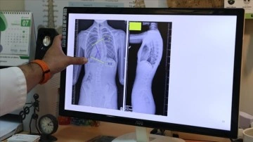 &Ccedil;ocuklarda ergenlik &ouml;ncesi skolyoz kontrol&uuml; tedavi şansını artırıyor