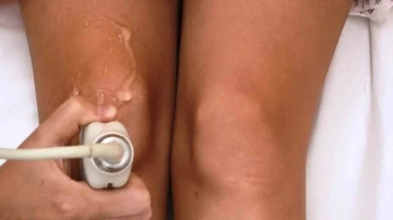 Diz kire&ccedil;lenmesine bebeklerin g&ouml;bek kordonuyla tedavi
