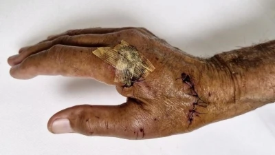 Duşakabin patladı, eline 20&rsquo;ye yakın dikiş atıldı