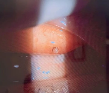 &lsquo;G&ouml;z kapağını ısıran kene, g&ouml;rme kaybına yol a&ccedil;abilir&rsquo;
