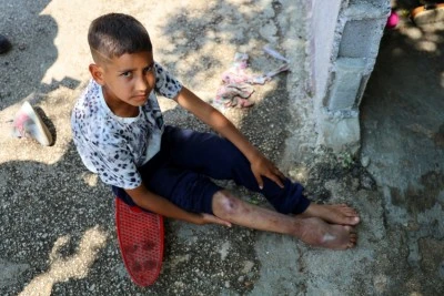 Kaza sonrası ayağı yanlış kaynadı