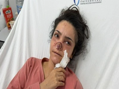 Kocası tarafından burnu kopartıldı