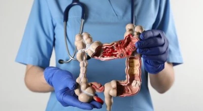 Kolon kanseri vakalarında artış