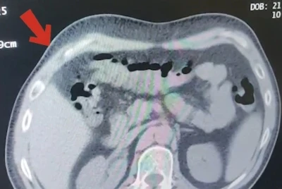 Mide ve bağırsaklarından 608 gram metamfetamin &ccedil;ıktı