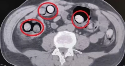 Mide ve bağırsaklarından 758 gram uyuşturucu &ccedil;ıktı