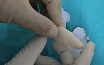 Osmaniye&rsquo;de ilk kez 3D yazıcı tekniğiyle kafatası ameliyatı
