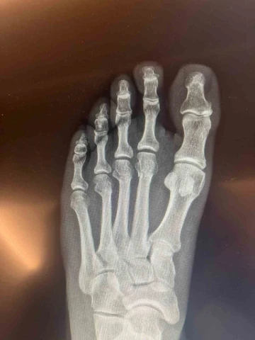 &Ouml;zg&uuml;r &Ouml;zel &lsquo;ayağından vuruldu&rsquo; iddialarına ilişkin kırılan ayağının r&ouml;ntgen filmlerini paylaştı
