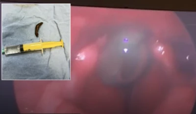 Şiddetli boğaz ağrısı şikayetiyle hastaneye gitti, sebebi şoke etti