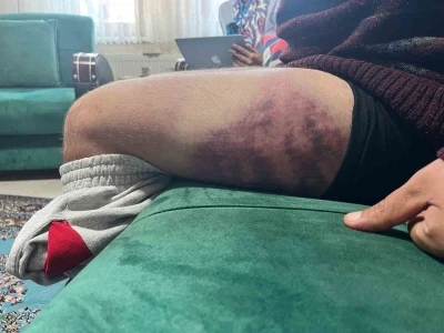 Otizmli birey odunluğa baktı diye odunla darp edildi