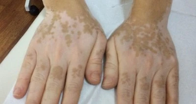 Vitiligo hastalığı tedavi edilebilir mi?