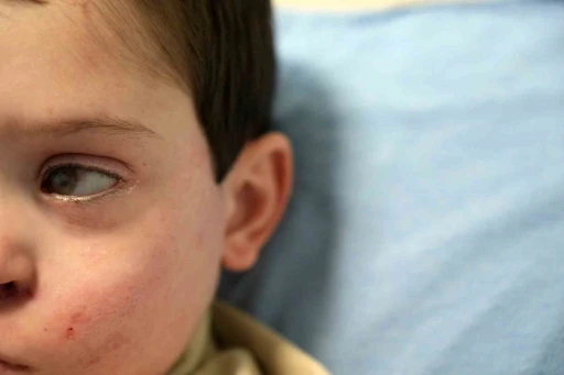 Y&uuml;z&uuml;n&uuml;n sol tarafı fel&ccedil; olan 4 yaşındaki Burak&rsquo;a &rsquo;akupunktur&rsquo; tedavisi umut oldu
